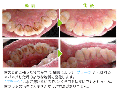プロの歯みがき術前、術後